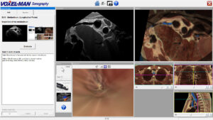 Visualization of the aortic arch: EUS (top left), anatomy (right), endoscope (bottom left) and position of the probe (right)